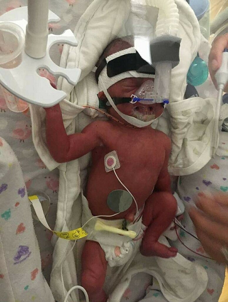 One-day-old Bellanie rests in the NICU, July 2017. She would go on to spend 87 more days in the care of doctors, nurses, and other staff. (Photo/Leondra Holman)