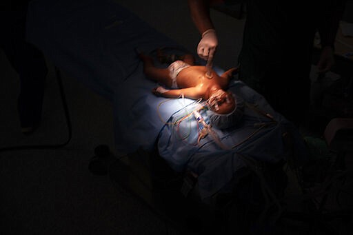 Yazan, 1, is prepared for his heart surgery at the Tajoura National Heart Center in Tripoli, Libya, on Feb. 27, 2020. He was born with congenital heart disease. With just one chamber, the organ pumped so little blood that when Yazan cried, his skin turned black. Without surgery, he would not survive. (AP Photo/Felipe Dana)