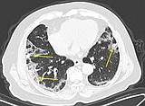 COVID-19 lung patterns show few clues for treating pneumonia