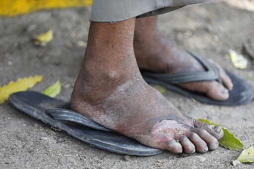 In this Monday, March 30, 2020, file photo, an injured foot of a daily wage laborer is seen as he rests on way to his village following a lockdown amid concern over spread of coronavirus on the outskirts of Prayagraj, India. Over the past week, India&#146;s migrant workers - the mainstay of the country&#146;s labor force - spilled out of big cities that have been shuttered due to the coronavirus and returned to their villages, sparking fears that the virus could spread to the countryside. It was an exodus unlike anything seen in India since the 1947 Partition, when British colothe subcontinent, with the 21-day lockdown leaving millions of migrants with no choice but to return to their home villages. (AP Photo/Rajesh Kumar Singh, File)