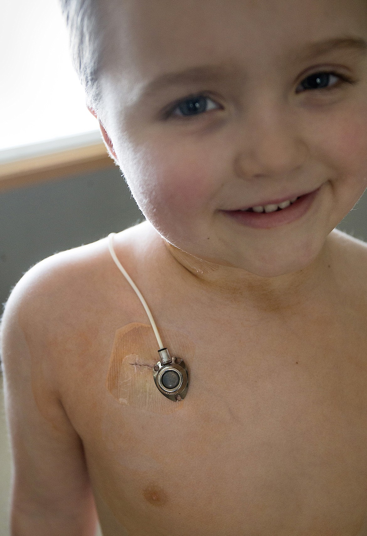 Tyce Fuqua, 5, shows his pump placed over the fresh scar where the pump was implanted for his chemotherapy. After three years and three months of treatment, the pump was removed last Friday after Tyce was declared cancer-free.