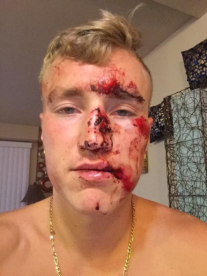 Christopher Tracy Baker posted this photo of himself, showing injuried he said received while walking home from work at The Coeur d'Alene Resort between 12:30 and 2 a.m. Baker told police a group of people demanded money from him and attacked and harassed him. Police are searching for at least one possible suspect.