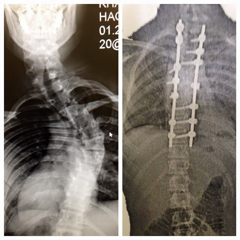 X-rays of Khalyn Hageness's spine before and after the surgery that fused the vertebrae in her upper back with steel rods. (Photo courtesy Kindra Hageness)