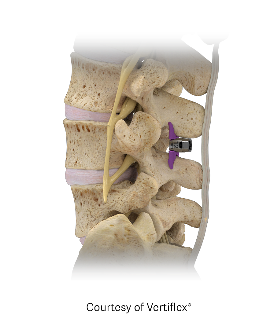 The Superion implant helps ease pain of lumbar spinal stenosis. (Photo courtesy of Vertiflex.)