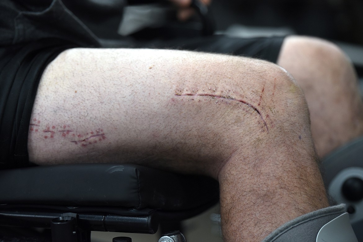 Marty Mann shows scars from a broken femur sustained after a cornice collapse and subsequent avalanche caused him to fall over 300 feet while riding a snow bike in the southern Swan Range on Saturday, Jan. 5. (Casey Kreider/Daily Inter Lake)