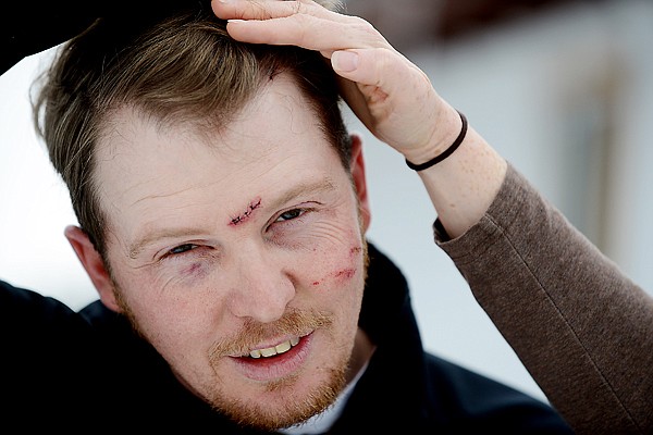 <p>Mike Stephens displays the wounds he received Thursday.</p><p></p>