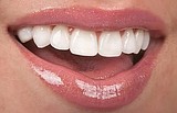Smiles under construction. Veneers valuable option to restore damaged teeth