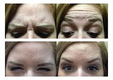 Injecting new life. Millions get anti-aging treatments on their faces annually