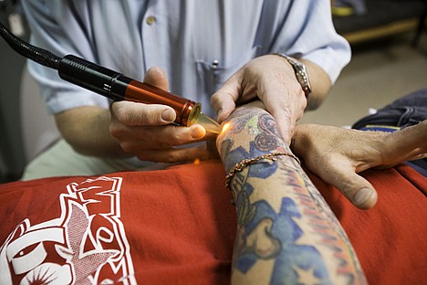 &lt;p&gt;Medical tattoo removal uses a concentrated laser to penetrate the skin and break down the ink.&lt;/p&gt;