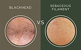 Is that sebaceous filament or blackheads?