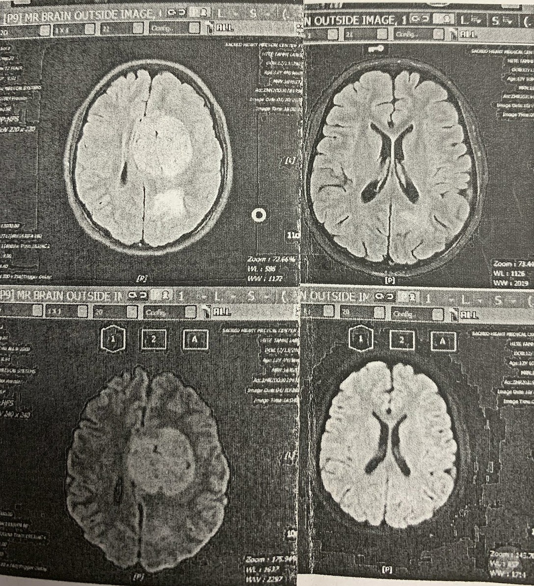 The scans of 12-year-old Tammi Hite's brain show a baseball-sized tumor above a wispy tumor earlier this year (top left) and how the tumors are now disappearing (bottom right).