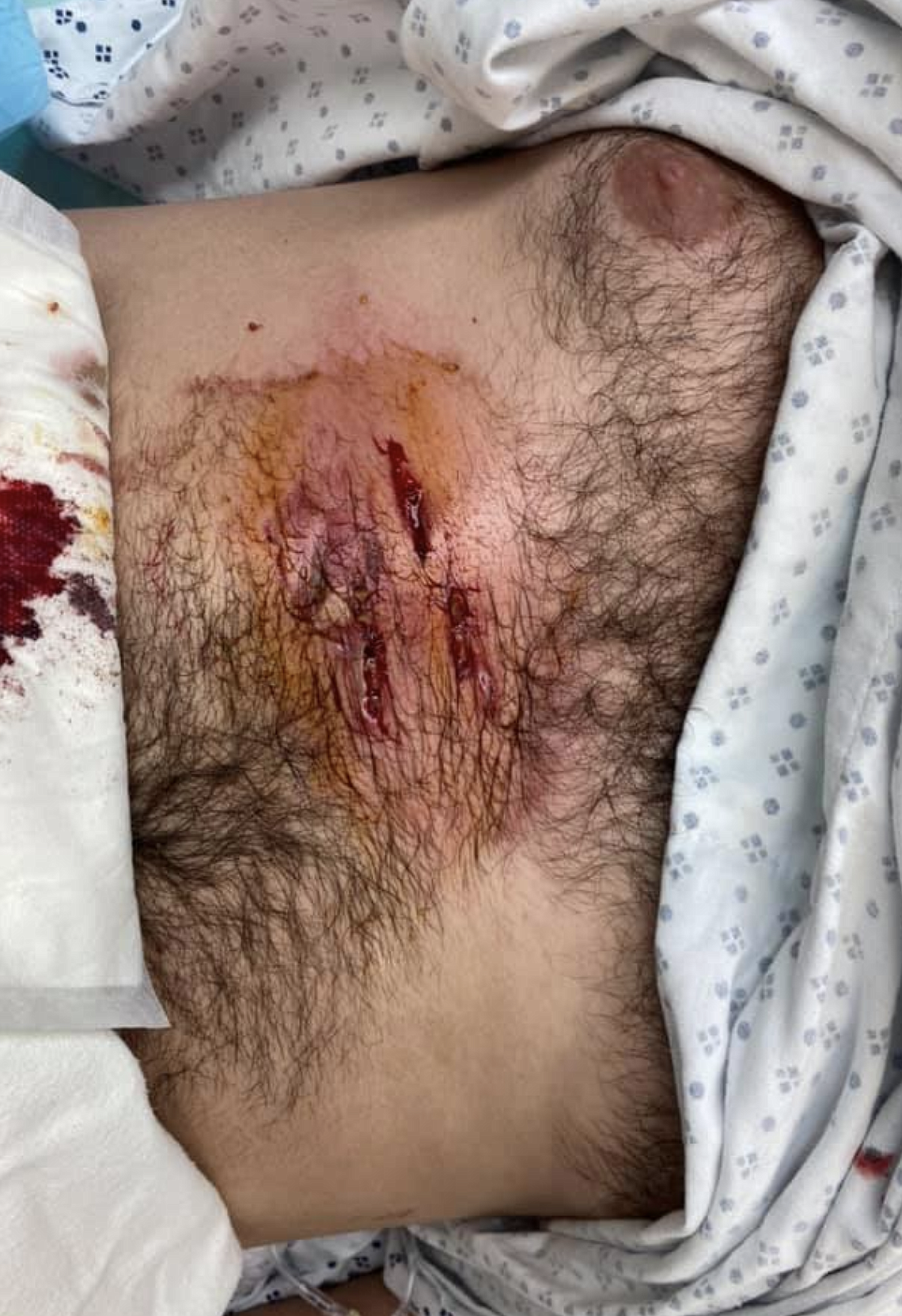 The bite marks Todd Newell Jr. received after the injured cougar latched onto his chest. These injuries and the others he received were all non-life threatening.
