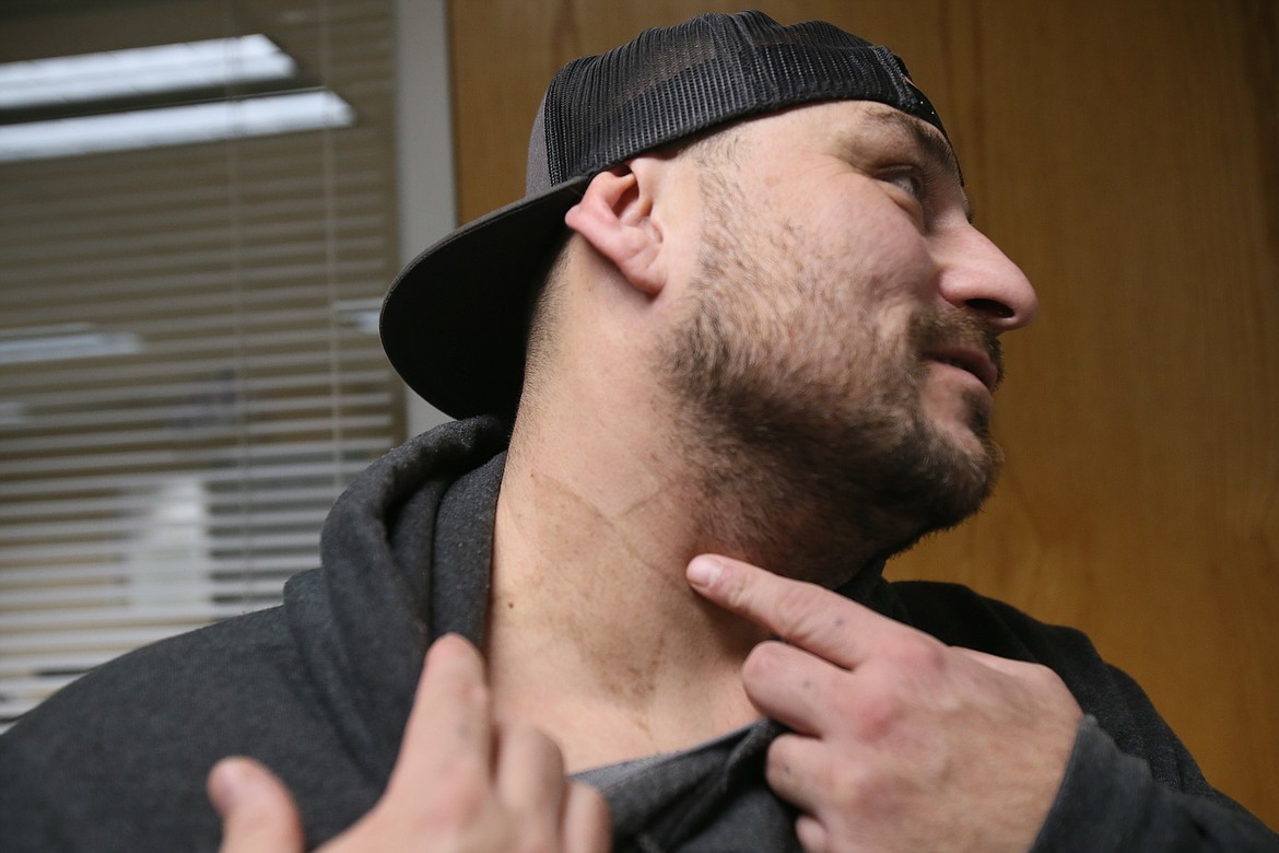 Paul Myers shows the remnants of a star tattoo that was inked into his neck while he was in prison. Myers, 39, is a proud daddy of two who has dreams of being a teacher to give back to a world that has given him a second chance. He is working to have the tattoos removed.