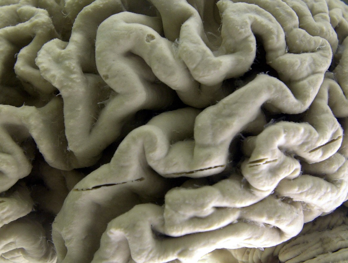 This Oct. 7, 2003 file photo shows a closeup of a human brain affected by Alzheimer's disease, on display at the Museum of Neuroanatomy at the University at Buffalo in Buffalo, N.Y. On Friday, Jan. 6, 2023, U.S. health officials approved Leqembi, a new Alzheimer’s drug that modestly slows the brain-robbing disease. The Food and Drug Administration granted the approval Friday for patients in the early stages of Alzheimer's. (AP Photo/David Duprey)