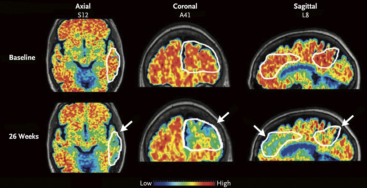 These PET scan images provided by the New England Journal of Medicine in January 2024 show a reduction in amyloid-beta levels in an Alzheimer's patient after focused ultrasound treatment to open the blood-brain barrier after 26 weeks. Red is associated with higher levels of amyloid-beta levels. Scientists have found a way to help Alzheimer’s drugs seep inside the brain faster — by temporarily breaching its protective shield.