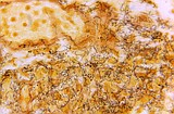 The US hasn't seen syphilis numbers this high since 1950