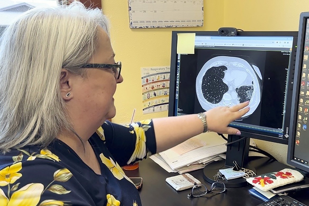 Dr. Lee Morissette shows an image of lungs damaged by asbestos exposure, April 4, 2024, at the Center for Asbestos Related Disease in Libby, Mont. (AP Photo/Matthew Brown, File)