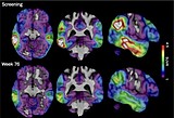 An experimental Alzheimer's drug shows promise targeting a different brain protein, new study shows